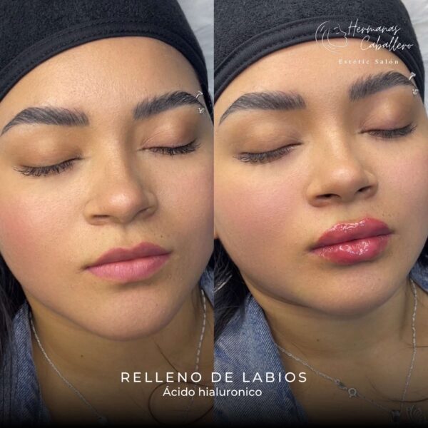 Relleno de Labios con Ácido Hialurónico